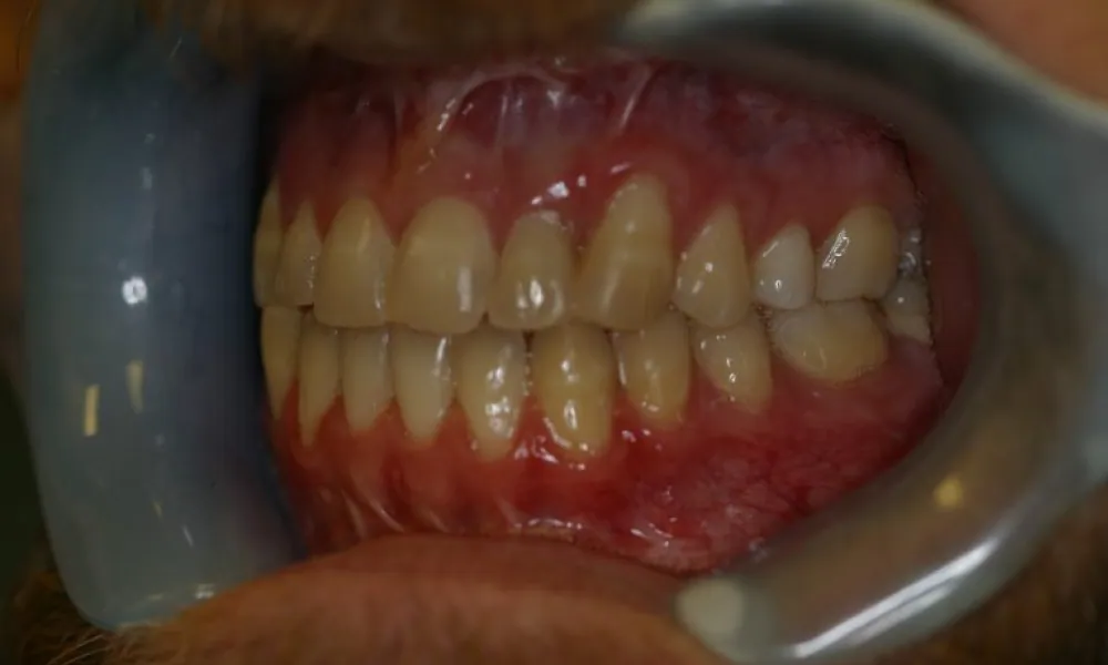 Clinical photo from Joe's corrective jaw surgery case